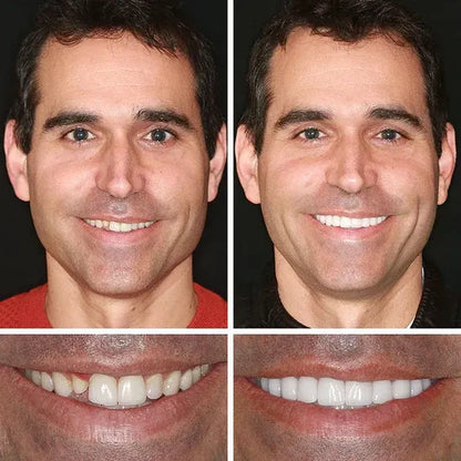 🌎Ends Today: 50% OFF! ⏰KLENIMORE™ Custom-Fit — Designed for Comfort and a Natural-Looking Smile