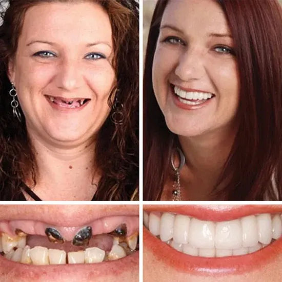 🌎Ends Today: 50% OFF! ⏰KLENIMORE™ Custom-Fit — Designed for Comfort and a Natural-Looking Smile