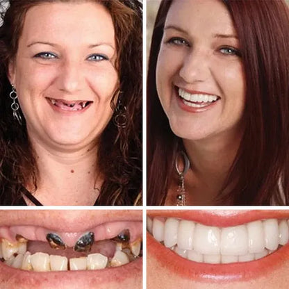 🌎Ends Today: 50% OFF! ⏰KLENIMORE™ Custom-Fit — Designed for Comfort and a Natural-Looking Smile