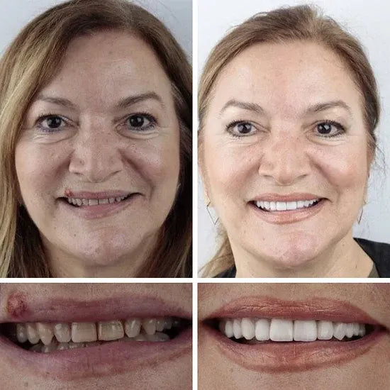 🌎Ends Today: 50% OFF! ⏰KLENIMORE™ Custom-Fit — Designed for Comfort and a Natural-Looking Smile